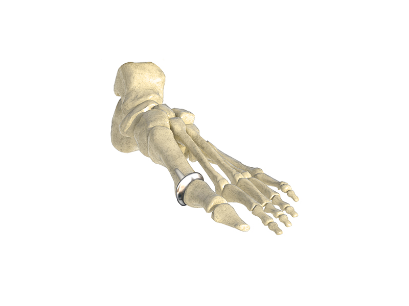 Small Joint System