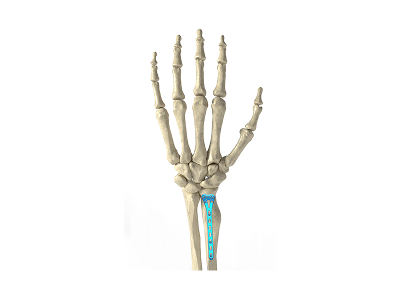 Bone Plate System