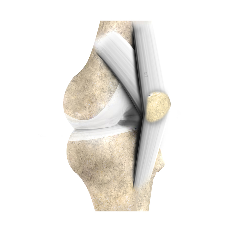 Artificial Patellar Tendon