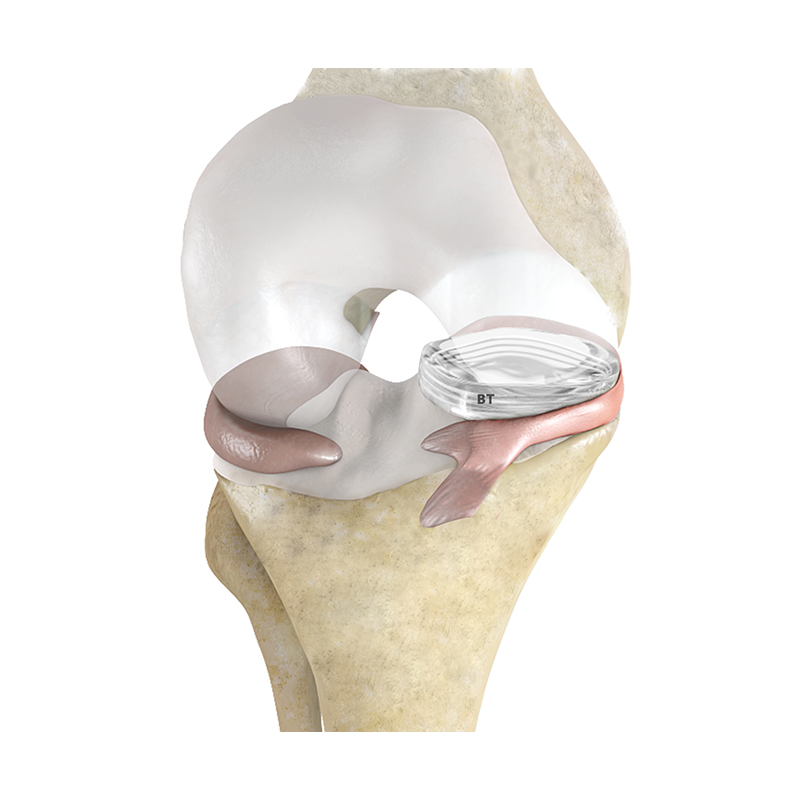 Artificial Meniscus