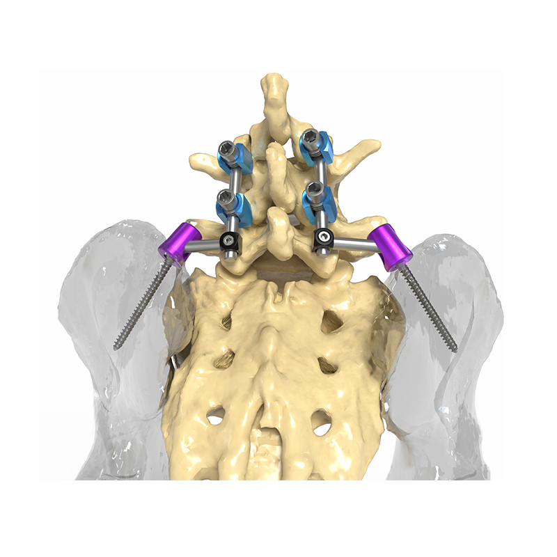 Thoracolumbar Posterior Spinal System