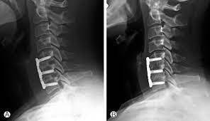 Anterior Cervical Plate X-ray