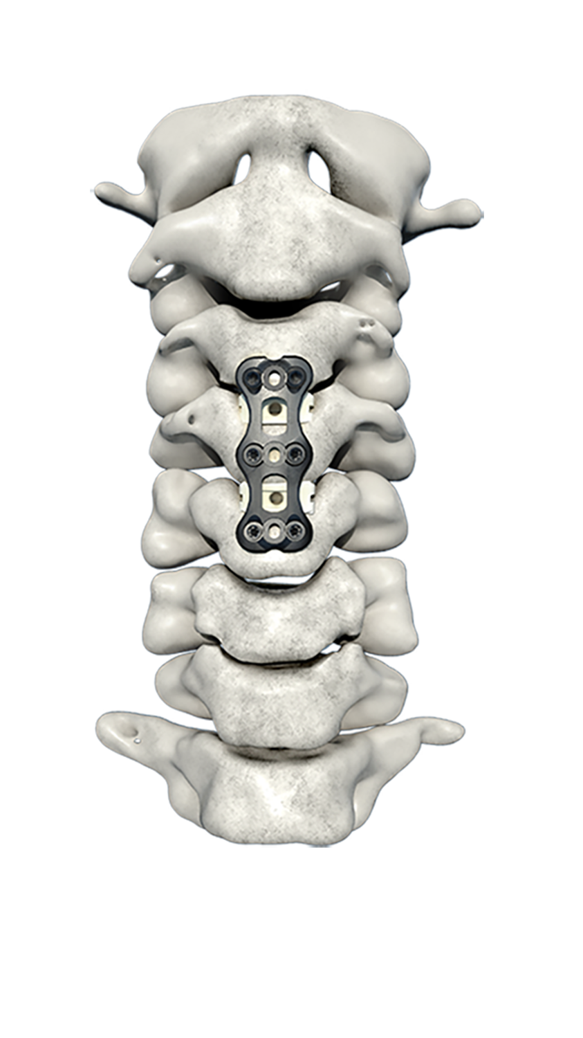 Anterior Cervical Plate