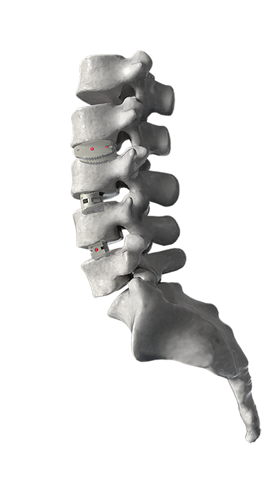 Thoracolumbar System