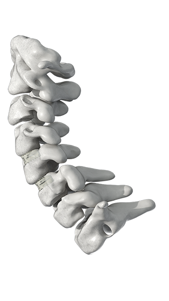 Cervical Fusion Cage