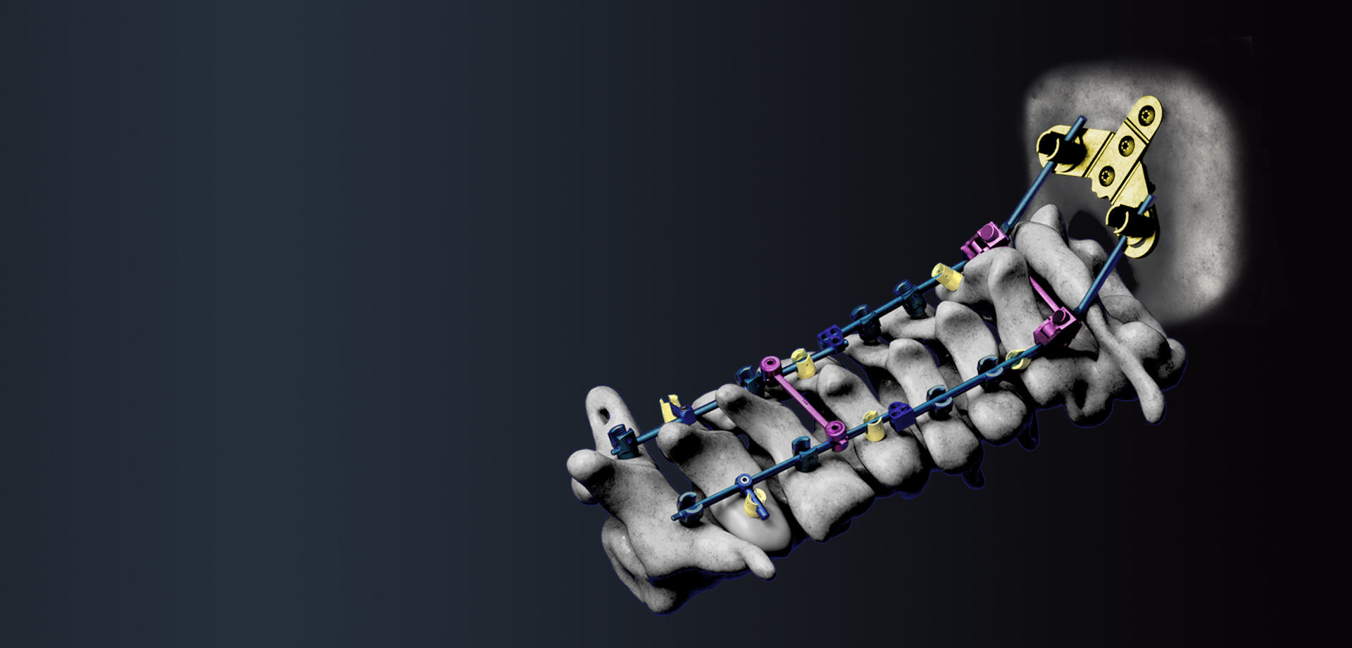 Cervical Spinal System