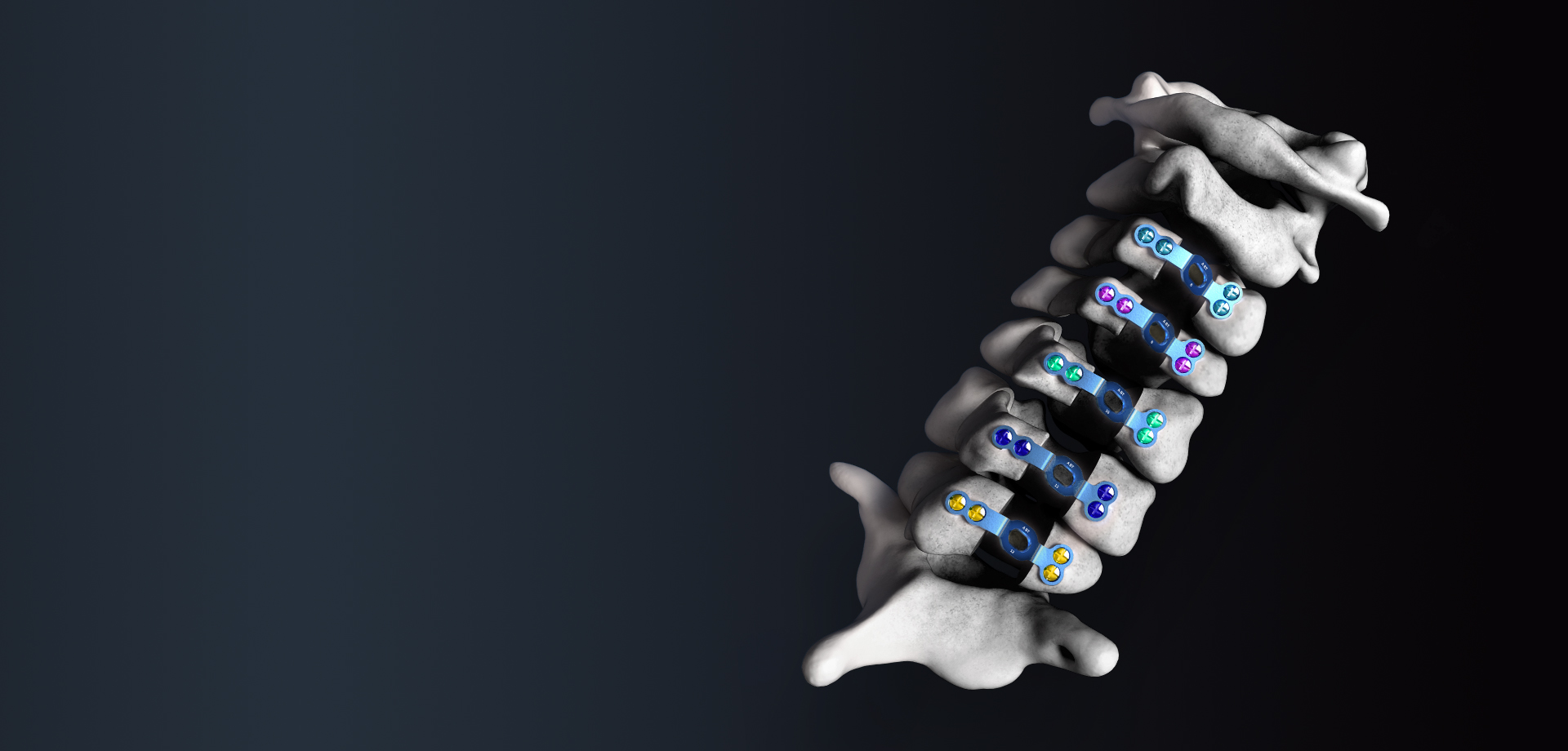 Lumbar Fixation Plate System