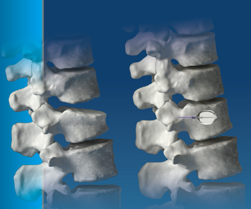Kyphoplasty System 